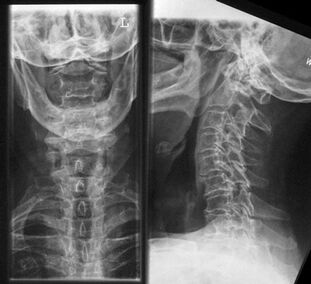 Рентгенова снимка на шийните прешлени - метод за диагностика на остеохондроза