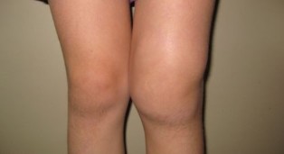 Деформация на коляното
