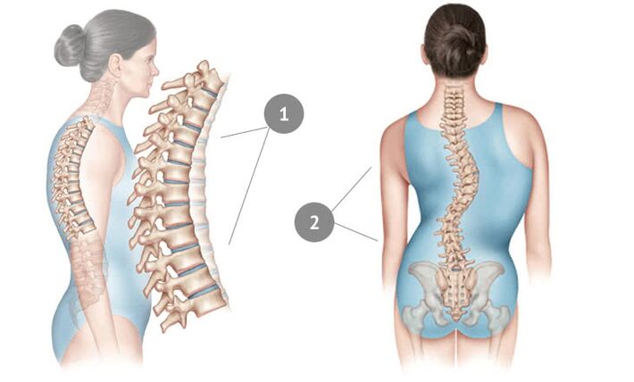 изкривяване на гръбначния стълб като причина за гръдна остеохондроза