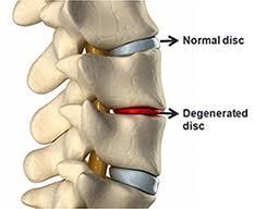 нормален диск на гръбначния стълб, повреден диск